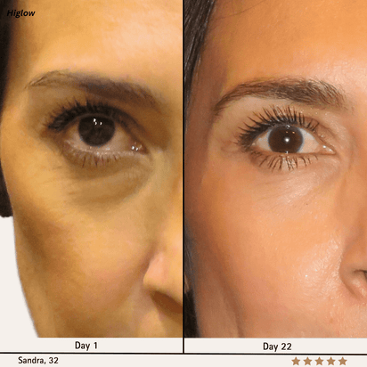 Higlow Retinal Shot - My Store